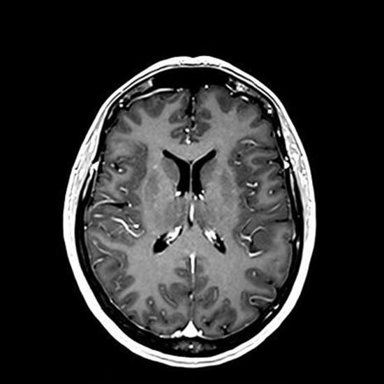 MRI Brain With Contrast? What It Is, Purpose, Procedure and Results